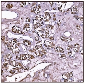 IHC staining of FFPE human adrenal cortical adenocarcinoma tissue with Glutamate-oxaloacetate transaminase 2 antibody. HIER: boil tissue sections in pH8 EDTA for 20 min and allow to cool before testing.
