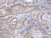 IHC staining of FFPE human laryngeal squamous cell carcinoma tissue with Integrin linked protein kinase antibody. HIER: boil tissue sections in pH8 EDTA for 20 min and allow to cool before testing.
