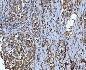 IHC staining of FFPE human breast cancer tissue with Integrin linked protein kinase antibody. HIER: boil tissue sections in pH8 EDTA for 20 min and allow to cool before testing.