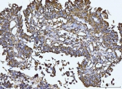 IHC staining of FFPE bladder epithelial carcinoma tissue with Integrin linked protein kinase antibody. HIER: boil tissue sections in pH8 EDTA for 20 min and allow to cool before testing.