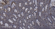 IHC staining of FFPE human rectal cancer tissue with MIEF1 antibody. HIER: boil tissue sections in pH8 EDTA for 20 min and allow to cool before testing.