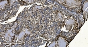 IHC staining of FFPE human renal clear cell carcinoma tissue with MIEF1 antibody. HIER: boil tissue sections in pH8 EDTA for 20 min and allow to cool before testing.