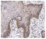 IHC staining of FFPE human esophageal squamous carcinoma tissue with PFKFB2 antibody. HIER: boil tissue sections in pH8 EDTA for 20 min and allow to cool before testing.