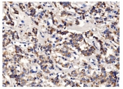 IHC staining of FFPE human cortical adenoma tissue with PFKFB2 antibody. HIER: boil tissue sections in pH8 EDTA for 20 min and allow to cool before testing.