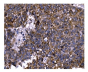 IHC staining of FFPE human liver cancer tissue with PFKFB2 antibody. HIER: boil tissue sections in pH8 EDTA for 20 min and allow to cool before testing.