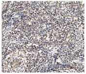 IHC staining of FFPE human testicular cancer tissue with PFKFB2 antibody. HIER: boil tissue sections in pH8 EDTA for 20 min and allow to cool before testing.