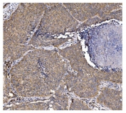 IHC staining of FFPE human lung cancer tissue with PFKFB2 antibody. HIER: boil tissue sections in pH8 EDTA for 20 min and allow to cool before testing.