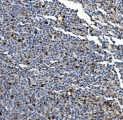 IHC staining of FFPE human lymphoma tissue with Proteasome subunit beta type-5 antibody. HIER: boil tissue sections in pH8 EDTA for 20 min and allow to cool before testing.