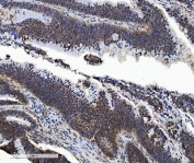 IHC staining of FFPE human rectal cancer tissue with Proteasome subunit beta type-5 antibody. HIER: boil tissue sections in pH8 EDTA for 20 min and allow to cool before testing.