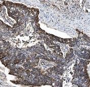 IHC staining of FFPE human ovarian serous adenocarcinoma tissue with Proteasome subunit beta type-5 antibody. HIER: boil tissue sections in pH8 EDTA for 20 min and allow to cool before testing.