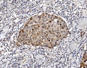 IHC staining of FFPE human breast cancer tissue with Proteasome subunit beta type-5 antibody. HIER: boil tissue sections in pH8 EDTA for 20 min and allow to cool before testing.