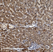 IHC staining of FFPE human liver cancer tissue with Proteasome subunit beta type-5 antibody. HIER: boil tissue sections in pH8 EDTA for 20 min and allow to cool before testing.