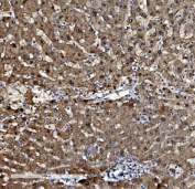 IHC staining of FFPE human liver cancer tissue with Proteasome subunit beta type-5 antibody. HIER: boil tissue sections in pH8 EDTA for 20 min and allow to cool before testing.