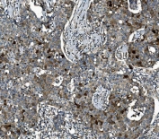 IHC staining of FFPE human breast cancer tissue with SEC14L3 antibody. HIER: boil tissue sections in pH8 EDTA for 20 min and allow to cool before testing.