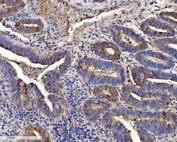IHC staining of FFPE human gallbladder adenocarcinoma tissue with SEC14L3 antibody. HIER: boil tissue sections in pH8 EDTA for 20 min and allow to cool before testing.