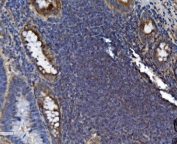 IHC staining of FFPE human rectal cancer tissue with SEC14L3 antibody. HIER: boil tissue sections in pH8 EDTA for 20 min and allow to cool before testing.