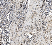 IHC staining of FFPE human gastric cancer tissue with SEC14L3 antibody. HIER: boil tissue sections in pH8 EDTA for 20 min and allow to cool before testing.