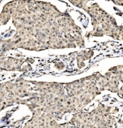 IHC staining of FFPE human breast cancer tissue with SND1 antibody. HIER: boil tissue sections in pH8 EDTA for 20 min and allow to cool before testing.