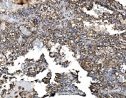 IHC staining of FFPE human renal clear cell carcinoma tissue with Astrin antibody. HIER: boil tissue sections in pH8 EDTA for 20 min and allow to cool before testing.