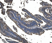 IHC staining of FFPE human rectal cancer tissue with Astrin antibody. HIER: boil tissue sections in pH8 EDTA for 20 min and allow to cool before testing.