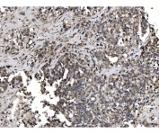 IHC staining of FFPE human gastric cancer tissue with Astrin antibody. HIER: boil tissue sections in pH8 EDTA for 20 min and allow to cool before testing.