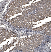 IHC staining of FFPE human liver cancer tissue with Astrin antibody. HIER: boil tissue sections in pH8 EDTA for 20 min and allow to cool before testing.