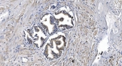 IHC staining of FFPE human prostate cancer tissue with STIL antibody. HIER: boil tissue sections in pH8 EDTA for 20 min and allow to cool before testing.