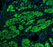 Immunofluorescent staining of FFPE human esophagus cancer tissue with TAGLN antibody (green) and DAPI nuclear stain (blue). HIER: steam section in pH8 EDTA buffer for 20 min.