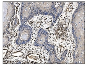 IHC staining of FFPE human esophageal squamous carcinoma tissue with TAGLN antibody. HIER: boil tissue sections in pH8 EDTA for 20 min and allow to cool before testing.