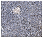 IHC staining of FFPE human lymphoma tissue with TAGLN antibody. HIER: boil tissue sections in pH8 EDTA for 20 min and allow to cool before testing.
