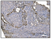 IHC staining of FFPE human lung cancer tissue with TAGLN antibody. HIER: boil tissue sections in pH8 EDTA for 20 min and allow to cool before testing.