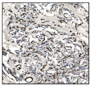 IHC staining of FFPE human adrenal cortical adenocarcinoma tissue with TAGLN antibody. HIER: boil tissue sections in pH8 EDTA for 20 min and allow to cool before testing.