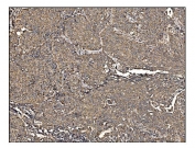 IHC staining of FFPE human lung cancer tissue with Antizyme inhibitor 2 antibody. HIER: boil tissue sections in pH8 EDTA for 20 min and allow to cool before testing.
