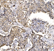 IHC staining of FFPE human lung cancer with CASP9 antibody. HIER: boil tissue sections in pH8 EDTA for 20 min and allow to cool before testing.
