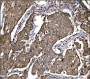 IHC staining of FFPE human breast cancer with CASP9 antibody. HIER: boil tissue sections in pH8 EDTA for 20 min and allow to cool before testing.