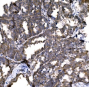 IHC staining of FFPE human ovarian cancer with CASP9 antibody. HIER: boil tissue sections in pH8 EDTA for 20 min and allow to cool before testing.