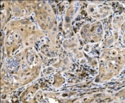 IHC staining of FFPE human gallbladder adenocarcinoma tissue with CASP9 antibody. HIER: boil tissue sections in pH8 EDTA for 20 min and allow to cool before testing.