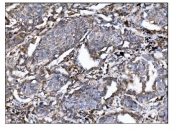 IHC staining of FFPE human lung cancer tissue with CTLA4 antibody. HIER: boil tissue sections in pH8 EDTA for 20 min and allow to cool before testing.