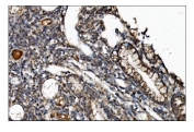 IHC staining of FFPE human gallbladder adenocarcinoma tissue with CTLA4 antibody. HIER: boil tissue sections in pH8 EDTA for 20 min and allow to cool before testing.