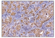IHC staining of FFPE human gallbladder adenocarcinoma tissue with Deoxyhypusine synthase antibody. HIER: boil tissue sections in pH8 EDTA for 20 min and allow to cool before testing.