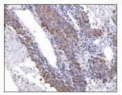 IHC staining of FFPE human liver cancer tissue with DLGAP1 antibody. HIER: boil tissue sections in pH8 EDTA for 20 min and allow to cool before testing.
