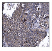 IHC staining of FFPE human lung cancer tissue with DLGAP1 antibody. HIER: boil tissue sections in pH8 EDTA for 20 min and allow to cool before testing.
