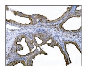 IHC staining of FFPE human ovarian cancer tissue with DLGAP1 antibody. HIER: boil tissue sections in pH8 EDTA for 20 min and allow to cool before testing.