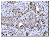 IHC staining of FFPE human breast cancer tissue with DLGAP1 antibody. HIER: boil tissue sections in pH8 EDTA for 20 min and allow to cool before testing.