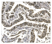 IHC staining of FFPE human rectal cancer tissue with EHMT2 antibody. HIER: boil tissue sections in pH8 EDTA for 20 min and allow to cool before testing.