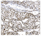IHC staining of FFPE human liver cancer tissue with EHMT2 antibody. HIER: boil tissue sections in pH8 EDTA for 20 min and allow to cool before testing.