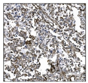 IHC staining of FFPE human gastric cancer tissue with CD39 antibody. HIER: boil tissue sections in pH8 EDTA for 20 min and allow to cool before testing.