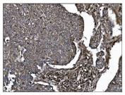 IHC staining of FFPE human lung cancer tissue with CD39 antibody. HIER: boil tissue sections in pH8 EDTA for 20 min and allow to cool before testing.