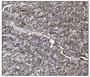 IHC staining of FFPE human liver cancer tissue with CD39 antibody. HIER: boil tissue sections in pH8 EDTA for 20 min and allow to cool before testing.
