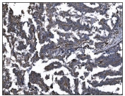 IHC staining of FFPE human ovarian cancer tissue with CD39 antibody. HIER: boil tissue sections in pH8 EDTA for 20 min and allow to cool before testing.